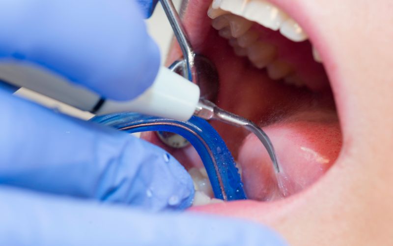 歯科治療に使う水｜香川県高松市の噛み合わせ専門歯科医院　吉本歯科医院